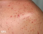 malassezia folliculitis