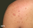 malassezia folliculitis