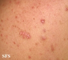 malassezia folliculitis