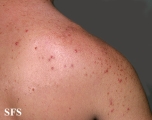 malassezia folliculitis