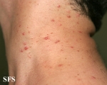 malassezia folliculitis