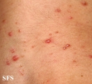 malassezia folliculitis