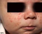 acne neonatorum