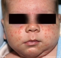 acne neonatorum