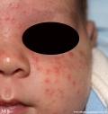 acne neonatorum