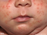 acne neonatorum