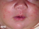 acne neonatorum