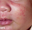 acne neonatorum