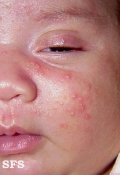 acne neonatorum
