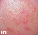 acne neonatorum