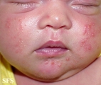 acne neonatorum