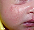 acne neonatorum