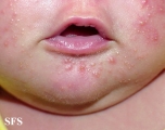 acne neonatorum