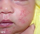 acne neonatorum