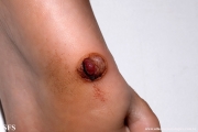 neurothekeoma-neurothekeoma_cellular