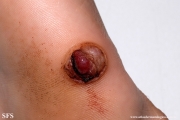neurothekeoma-neurothekeoma_cellular