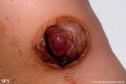 neurothekeoma-neurothekeoma_cellular