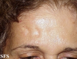 lipoatrophy-postherpertic lipoatrophy