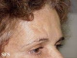 lipoatrophy-postherpertic lipoatrophy