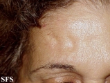 lipoatrophy-postherpertic lipoatrophy
