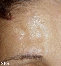 lipoatrophy-postherpertic lipoatrophy