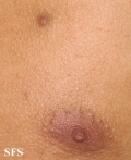 nipples supernumerary
