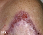 lupus vulgaris