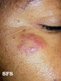 lymphocytic infiltration of the skin