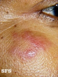 lymphocytic infiltration of the skin
