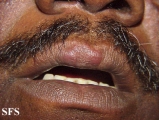 lymphocytic infiltration of the skin