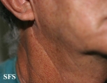 melanoma of the parotid