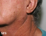 melanoma of the parotid