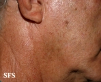 melanoma of the parotid