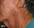 melanoma of the parotid
