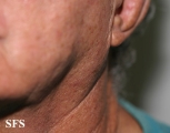 melanoma of the parotid