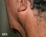 melanoma of the parotid