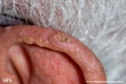 tumour_of_the_follicular_infundibulum