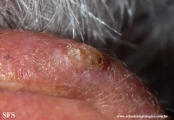 tumour_of_the_follicular_infundibulum