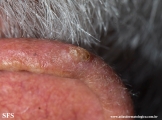 tumour_of_the_follicular_infundibulum