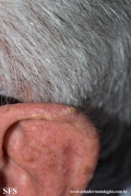 tumour_of_the_follicular_infundibulum