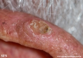 tumour_of_the_follicular_infundibulum
