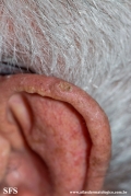 tumour_of_the_follicular_infundibulum