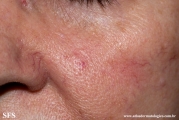 tumour_of_the_follicular_infundibulum