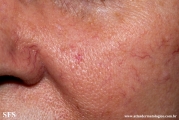 tumour_of_the_follicular_infundibulum