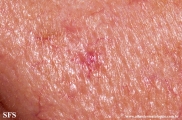 tumour_of_the_follicular_infundibulum