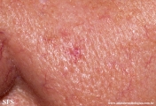 tumour_of_the_follicular_infundibulum