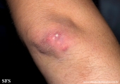 gout