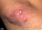 gout