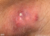 gout