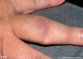 gout